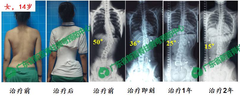 探索前沿：揭秘脊柱侧弯治疗的革命性最新技术突破